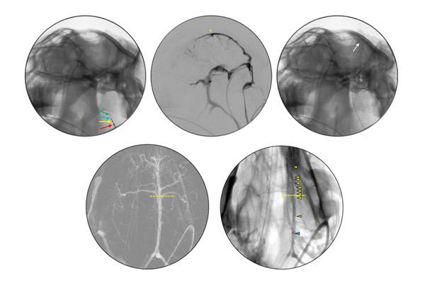 un-electrostent-evit