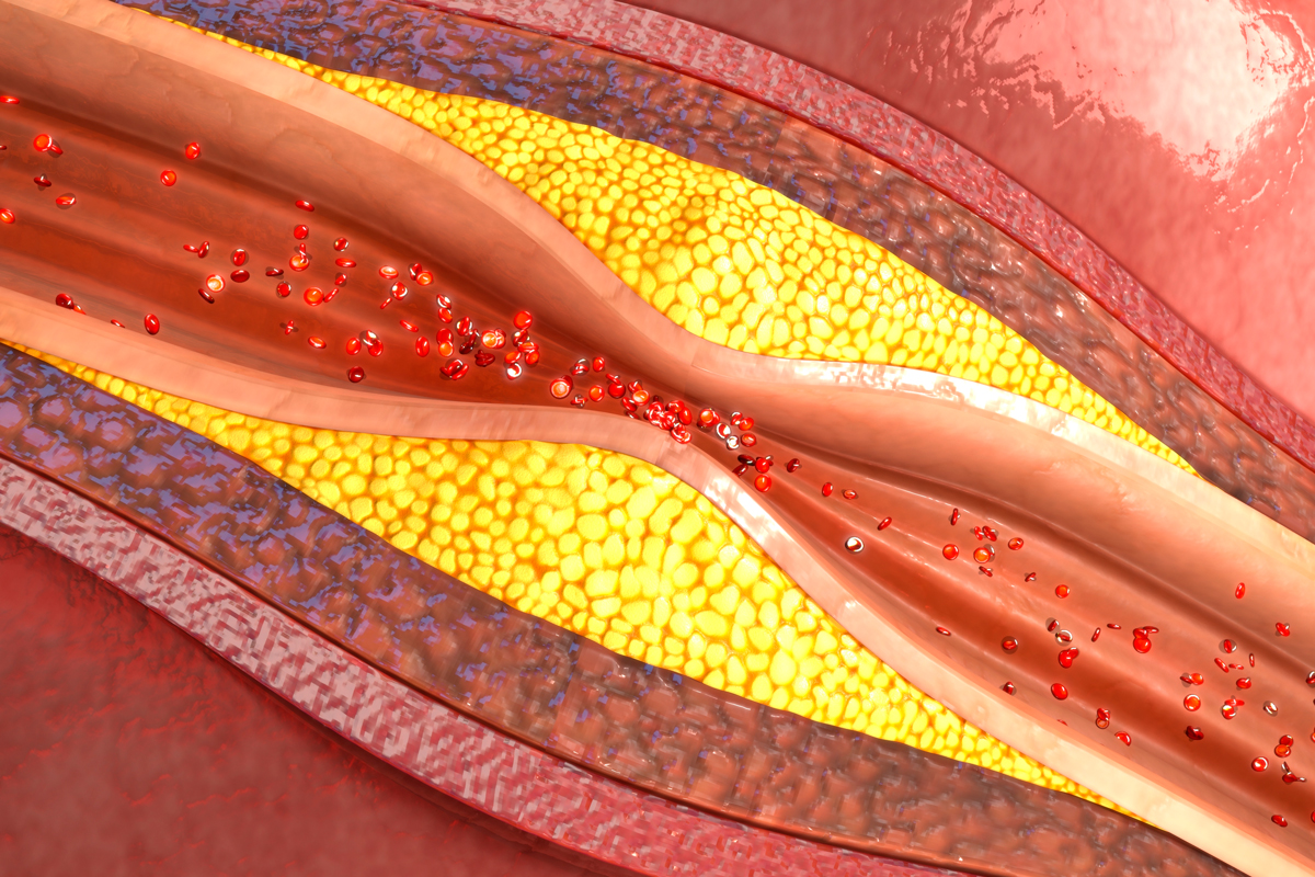 descubierto-el-mecanismo-por-el-que-el-colesterolldl-penetra-la-pared