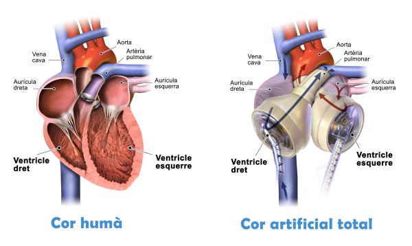 el-hospital-de-bellvitge-implanta-su-primer-corazon-artificial-total