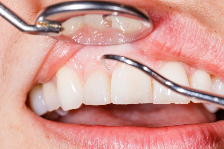 los-antiacidos-reducen-la-severidad-de-la-periodontitis